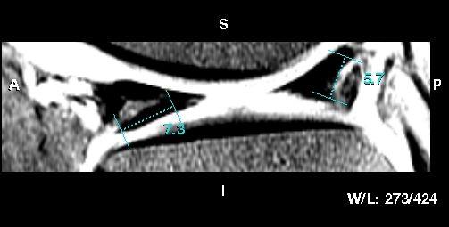MRI scan showing tears (grey areas) in the menisci (black triangles) The initial principals of treatment involve rest, ice, elevation and antiinflammatories, as well as physiotherapy modalities with