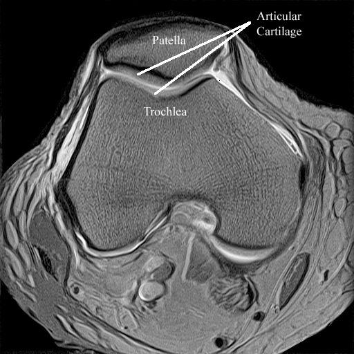 Chondral injuries (lining cartilage of the knee) The final common problem that runners may experience is damage to the lining surface of the knee (articular cartilage).