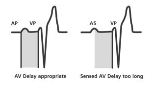 Optimization of AV Timing with MVDE Measure the intrinsic PR interval and program the AV delay to a shorter value Using mitral velocity Doppler echo (MVDE), record and observe the E and A waves
