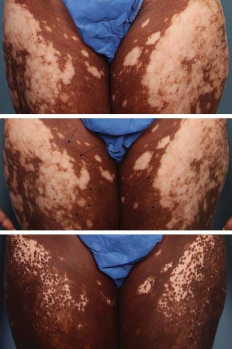 REPORT OF CASES All the patients in this case series were adults with generalized vitiligo of less than 5 years duration, with a 15% to 50% body surface involvement.