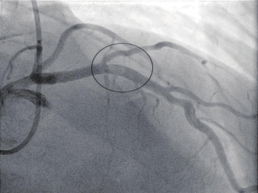 Cardiovascular Diagnosis and Therapy, Vol 5, No 4 August 2015 331 Figure 1 RAO cranial angiogram showing LAD thrombosis beyond the bifurcation with the first diagonal vessel (encircled).