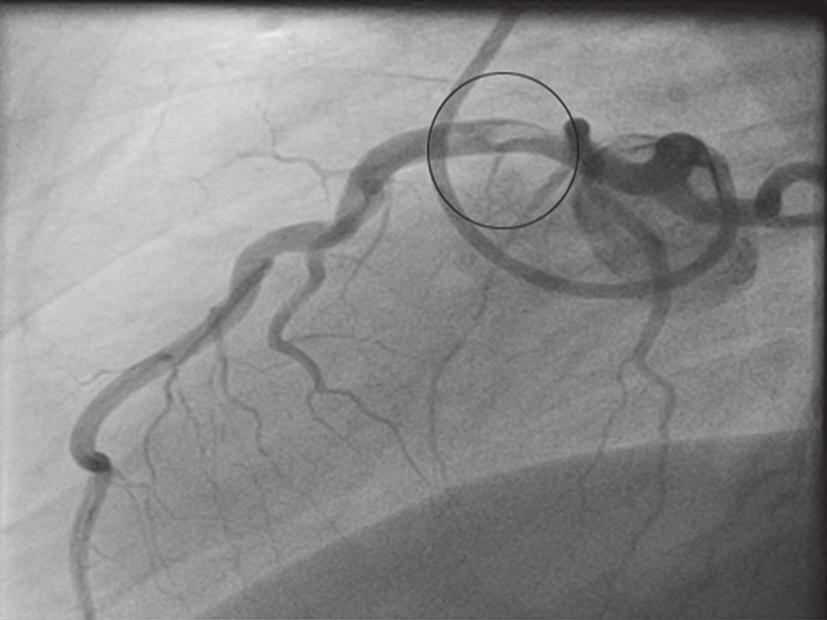 Figure 2 Lateral angiographic cine projection showing clear evidence of a large thrombus in the proximal LAD (2). LAD, left anterior descending. Available online: http://www.asvide.