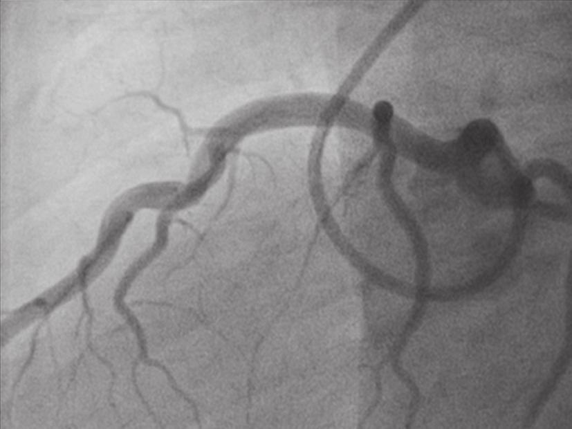 Cardiovascular Diagnosis and Therapy, Vol 5, No 4 August 2015 333 Figure 7 Final lateral angiogram showing complete resolution of thrombosis.