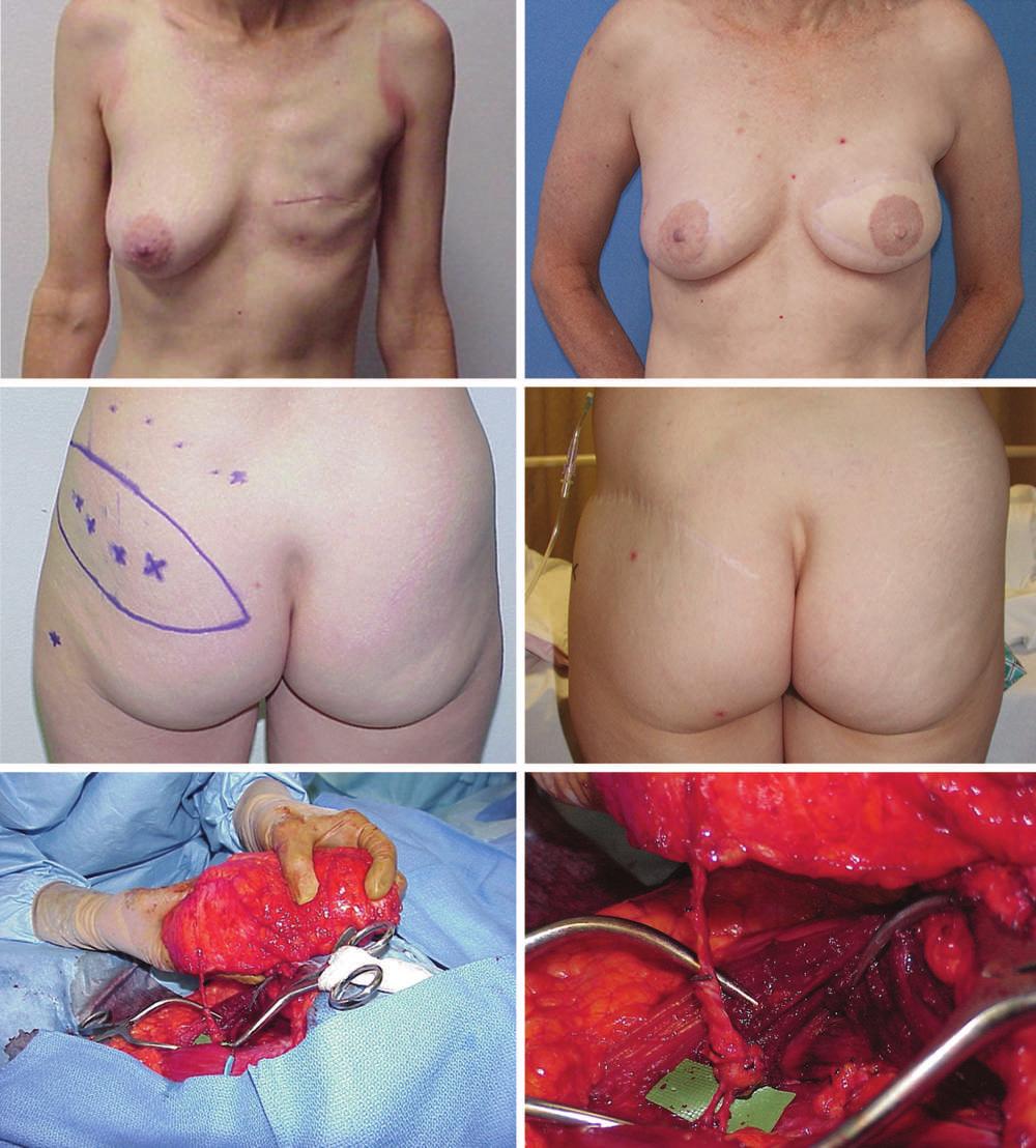 Plastic and Reconstructive Surgery July 2007 Fig. 5. (Above, left and center, left) Preoperative marking of patient to undergo left breast reconstruction with the SGAP flap.