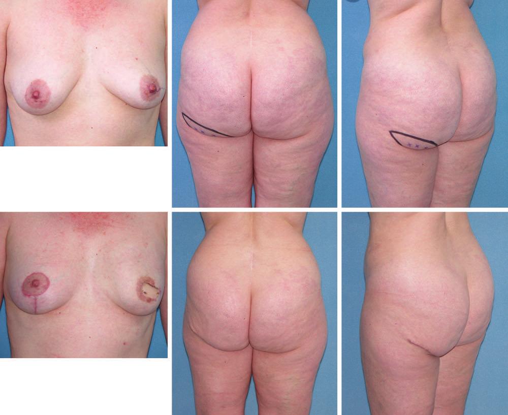 Volume 120, Number 1 Breast Reconstruction Fig. 6. (Above) Preoperative markings of patient to undergo left breast reconstruction with a left IGAP flap.