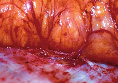 Plastic and Reconstructive Surgery July 2007 Fig. 1. Perforating vessels of the lateral branch of the deep inferior epigastric artery are visible coursing through the rectus sheath.