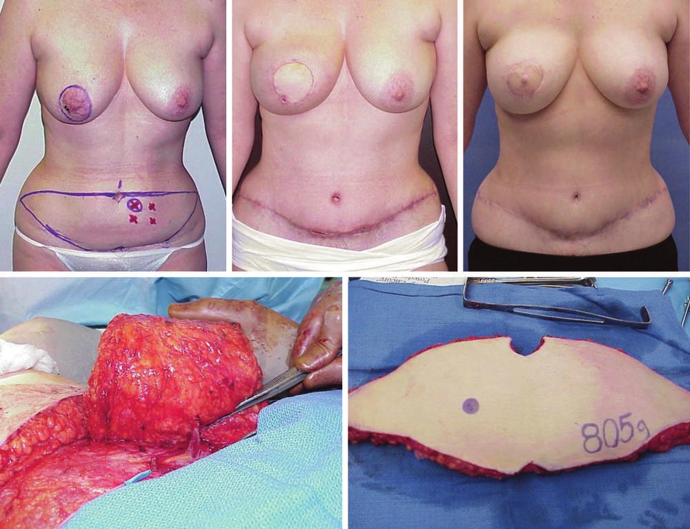 Volume 120, Number 1 Breast Reconstruction The insetting and closure are performed over a suction drain, and great care is used to monitor the integrity of the pedicle during the insetting of the