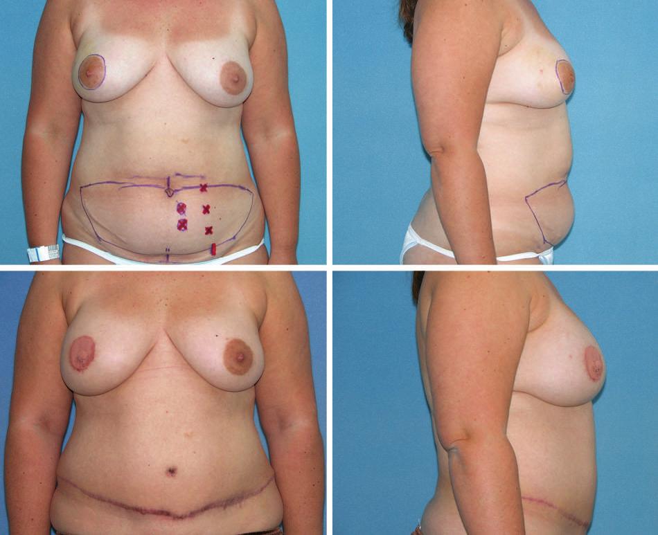 Plastic and Reconstructive Surgery July 2007 Fig. 3. (Above) Preoperative views of a patient with right breast carcinoma for mastectomy with DIEP flap reconstruction.