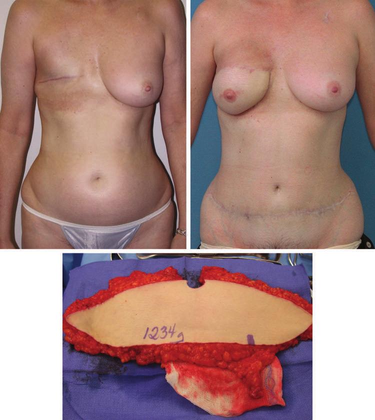 Plastic and Reconstructive Surgery July 2007 Fig. 4. (Above, left) Preoperative markings. (Below) The SIEA flap after harvest.
