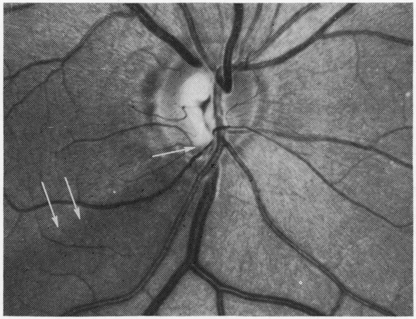 inferior pole of the right optic nerve head (Fig. 2). Development of this defect corresponded to progression of an early arcuate scotoma in the superior nasal field of that right eye.