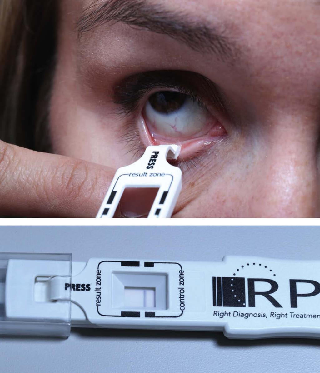 Dry Eye Diagnostic Tools of patients with SS are negative for the SS-A/Ro and SS-B/La testing.