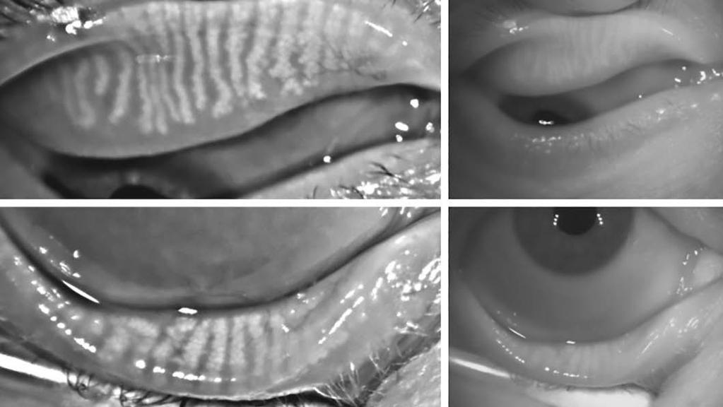 Figure 5: Meibography of the upper and lower lids addition, after sustained opening for 10 seconds, dry eye patients central corneal temperature becomes significantly lower where controls remain the