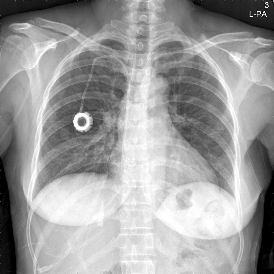 location, but a pinch-off sign showed as a catheter deviation between the clavicle and the first rib.