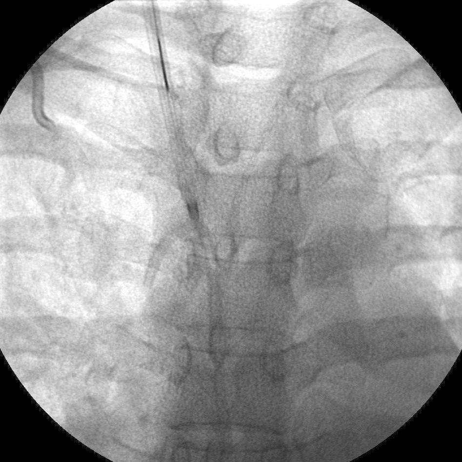 The patient was referred to an interventional radiologist, and the embolized catheter was successfully removed via the percutaneous approach through the right internal jugular vein under fluoroscopic