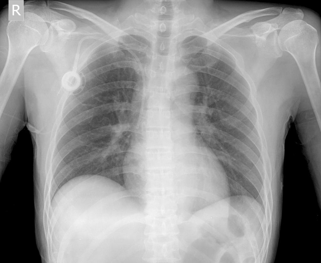 Fig. 7. Chest X-ray showed no deviation or luminal narrowing of central venous catheter representing pinch-off sign grade 0. Fig. 8.