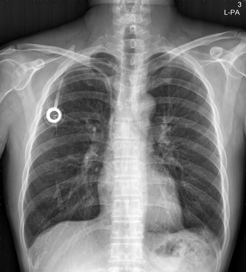 Before this, Aitken and Minton [4] named the chest X-ray findings that indicated impending subclavian catheter problems as pinch-off signs. Hinke et al.