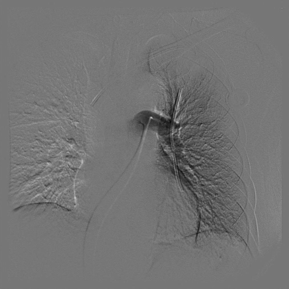 Fig. 10. Pulmonary arteriography showed transected catheter located inside pulmonary artery. syndrome was 5.