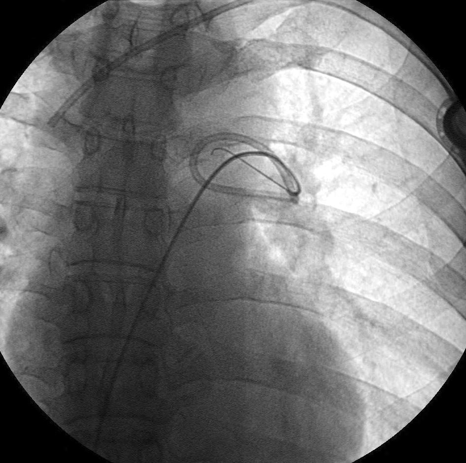 According to the collective review by Fisher and Ferreyro [6], the rate of serious complications related to embolized catheters including death was 71% in patients who had pinch-off syndrome, and