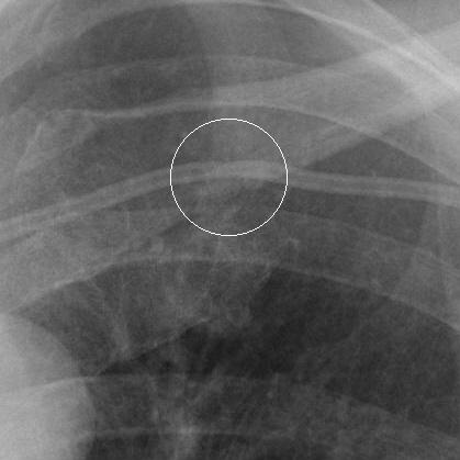 Pinch Off Syndrome Fig. 2. Chest X-ray after port insertion. A close-up of the left clavicle area (circled area) showed a slight compression of the catheter (Hinke s Grade 2).