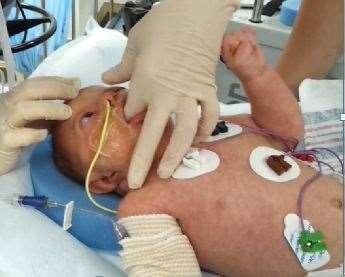 AWAKE SGA in infants with airway obstruction STEP 1 Administer an antisialagogue agent Lidocaine jelly applied by finger to the