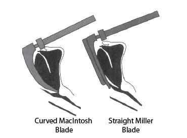 Endotracheal Intubation Tools: Laryngoscope Macintosh blade curved blade, rests on epiglottic vallecula Miller blade straight blade, lifts