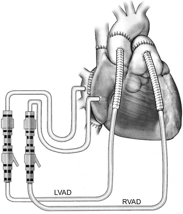 Cardiopulmonary Support and Physiology Petrofski et al Figure 1. A heart transplant is illustrated and a bicaval implant technique employed.