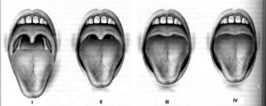 Oral Cavity-Mallampati I-Posterior pharyngeal wall+soft palate+uvula+hard palate