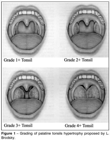 Tonsils Zero or 1-can t see 2+ evident on exam 3+large 4+ Kissing