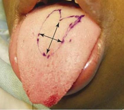 Tongue Recuction a.