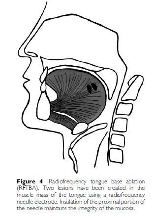 RFBOT RF BOT in 56 patients without palate or nasal obstruction RDI 41 Response rate of 20% (2A) or 33% (2D) Powell NB, Riley RW, Troell RJ et al.