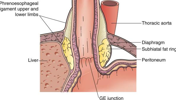 Phreno-oesophageal ligament Attaches GOJ to diaphragm i.e. oesophagus anteriorly to peritoneum and endo-abdominal fascia A
