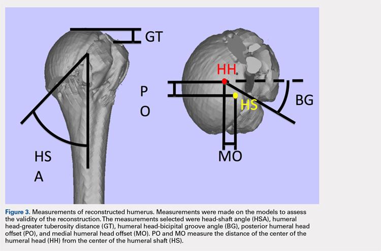 Table. Dimensions of Proximal Humerus Geometry Normal Parameters Average Dimensions From Trials Dimensions From Literature Head shaft angle 43.5 ± 1 42.5 ± 12.5 Head to greater tuberosity distance 4.