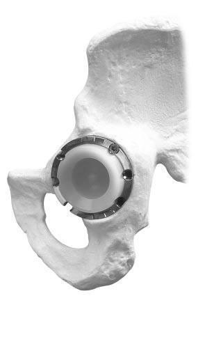 6Final Reduction With the Acetabular Cup implanted, reduce the hip and assess range of motion, stability, and