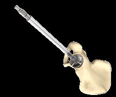 Begin reaming the acetabulum using the smallest reamer and increasing the reamer size until a perfectly formed hemispherical cavity has been created, in the presence of bleeding subchondral bone.