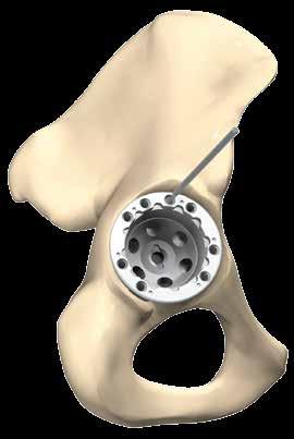 Screwing is performed with the aid of a 3.5 mm hexhead screwdriver. To insert cortical bone screws on the rim of the shell, drill through the acetabular shell rim holes using a Ø 3.0 mm drill bit.