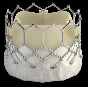Edwards SAPIEN 3 transcatheter heart valve 2 1 Outer Sealing Skirt Designed to minimise paravalvular leak 3 2 Frame Design Enhanced frame geometry for