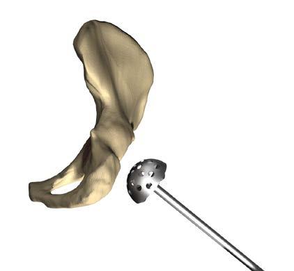 TaperFit Cenator cup acetabular preparation and implantation 6 Step 1. Reaming the acetabulum The acetabular rim is identified and any osteophytes and capsular remnants are removed.