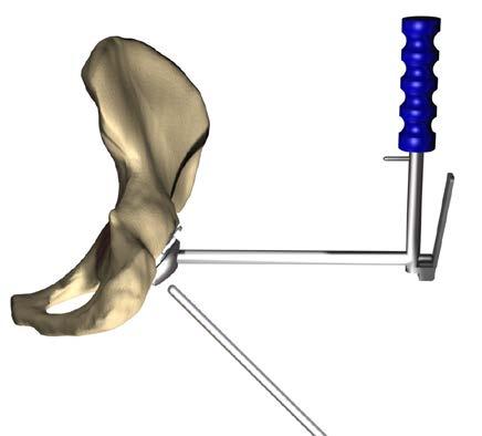 In order to ensure an adequate cement mantle, the final size of reamer used should be 4mm larger than the cup to be implanted, e.g. to accept a 44mm cup the acetabulum must be reamed to 48mm. Step 2.