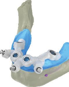 Allows customizable designs to realize tooth, gingiva, or bone-supported drill guides, plus combined variants and drill guides with palatal support and/or