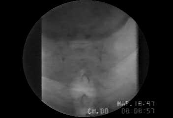 Example of Adult Anterior-