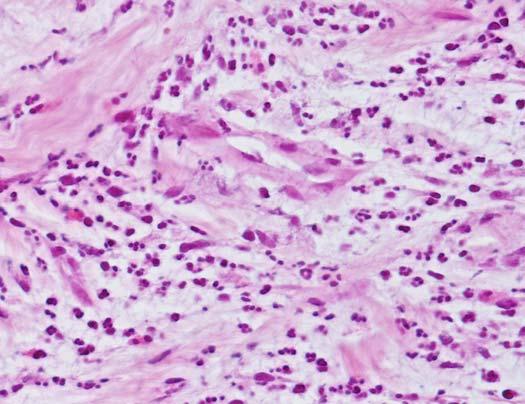 118 FROZEN SECTION LIBRARY: LUNG FIGURE 6.3. High-power view from a wedge biopsy frozen section containing neutrophils and granulation tissue.