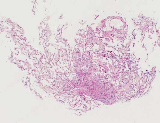 TB Cryobiopsy vs. Forceps TBBx Randomized trial published in 2014* 77 pts randomized Technique Specimen Size mm 2 Histologic Dx MMD Dx Complications Forceps TBBx 3.3 +/- 4.