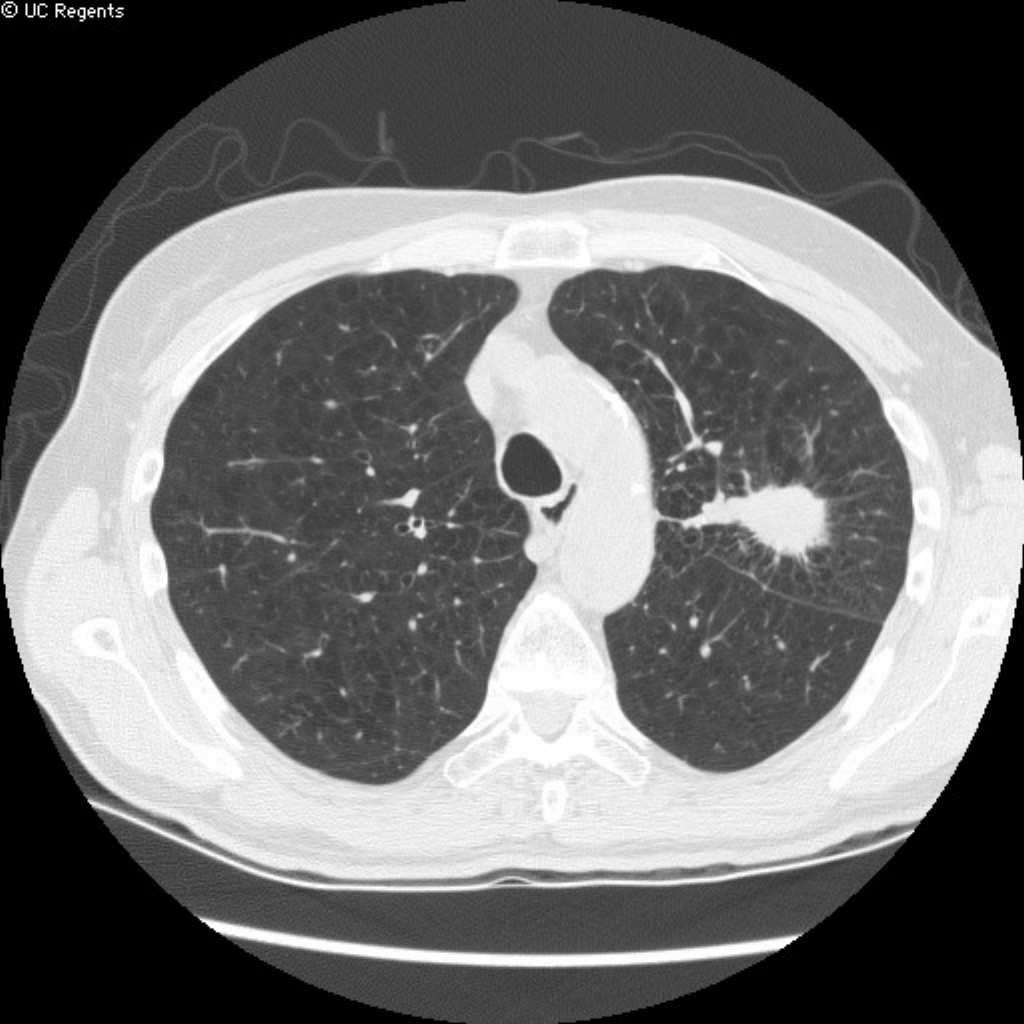 associated with smoking Rapid growth rate Poor prognosis PET positive CT determines next step of w/u Follow-up recommendations Nodule size