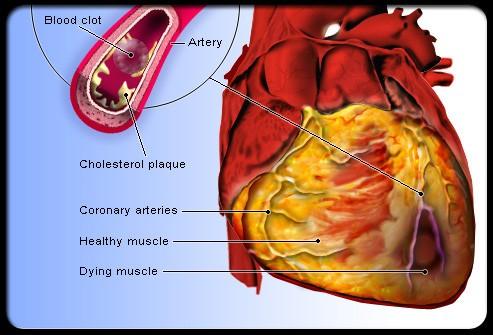 Heart disease begins when cholesterol, fatty material, and calcium build up in the arteries.