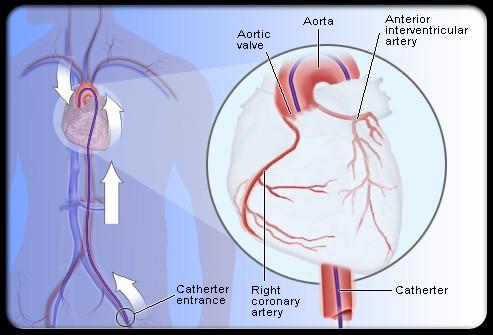 What makes coronary angiography a superior test compared to the others? During coronary angiography, doctors guide a catheter into the coronary arteries.