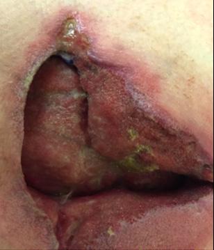 The wound granulated and filled progressively as observed on subsequent follow-up visits (Figure 5).