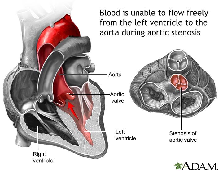In a normal aortic valve, there are three leaflets, all of which flip open to let the blood pass through into the aorta, and then flip closed, fitting together like pie pieces and creating a tight