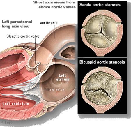 CAUSES There are two main types of aortic stenosis: Acquired aortic stenosis (senile): Develops later in life from calcium buildup on the edges of the leaflets causing them to fuse together.