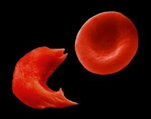 physical chemistry of haemoglobin S were understood - Renowned scientist Linus Pauling called sickle cell anemia the first molecular disease - Blood smear under the microscope