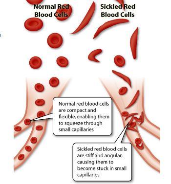 Sickle-Cell Disease (SDC) - Clinical condition that results from abnormally low numbers of red blood cells (RBCs) Cannot be treated by change in diet (increase of iron) - RBCs contain haemoglobin